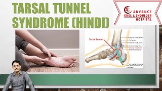 Tarsal Tunnel syndrome Hindi [upl. by Katherine836]