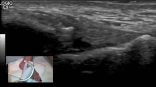 Anterior Cruciate Ligament ACL Tear  UPMC [upl. by Emmeram]