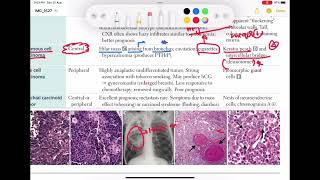 Squamous cell carcinoma of lung Respiratory 55  First Aid USMLE Step 1 in UrduHindi [upl. by Joleen612]