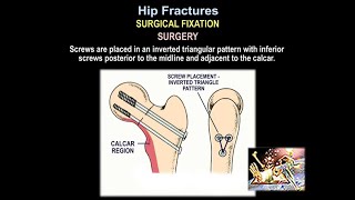 Hip Fractures Surgical Fixation  Everything You Need To Know  Dr Nabil Ebraheim [upl. by Arundel593]