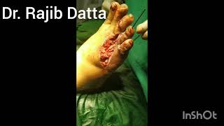 degloving injury of Foot and bony injury repaired by DrRqjib Datta [upl. by Grete346]