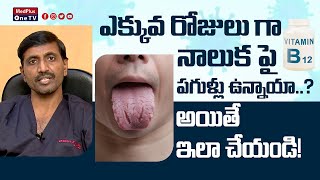 Fissured Tongue  Tongue Cracks Causes and Treatment l Dr Chava Anjaneyulu MedPlusONETV [upl. by Riess]