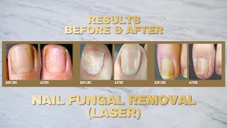 Fungal Nail Treatment  Fotona Laser [upl. by Aileduab]