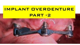 Implant Overdenture Planning  Part 2 Implant Supported Overdenture  Step by Step Planning [upl. by Nahtnanhoj]