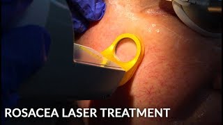 Treating Rosacea with Vascular Laser Excel V  Live [upl. by Langill]