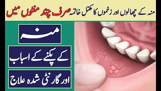 Munh Ke Chalon Ka Totka  Muh ka Pak Jana  Canker SoreMouth Ulcers Treatment in UrduHindi [upl. by Petunia343]