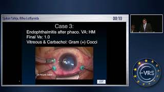 An Outbreak of Postsurgical Endophthalmitis Due to Contaminated Carbachol Solution [upl. by Boggers111]