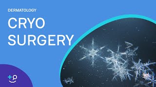 Cryo Surgery Procedure Freezing [upl. by Spalding]