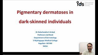 Pigmentary Dermatosis in dark skinned individuals  Dr Balachandra Ankad [upl. by Ashil]