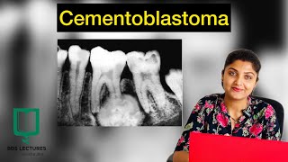 Cementoblastoma  Odontogenic Tumour  Lecture  24  Oral Pathology [upl. by Sirrad]