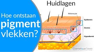 PIGMENTVLEKKEN  Hoe ontstaan pigmentvlekken  Wat zijn pigmentvlekken [upl. by Yknip]