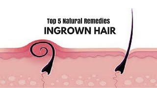 Get Rid of Ingrown Hair  Natural Home Remedies for Ingrown Hair Removal [upl. by Aryajay]