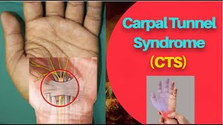 Carpal Tunnel Syndrome CTS  Median Nerve Compression  PhysiotherapyKnowledge [upl. by Yerbua]