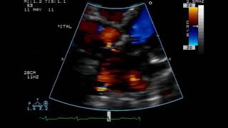 Atrial Septal Defect  Ostium Secundum Type  TTE [upl. by Aonehc]