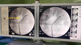 RIRS  Retrograde Intrarenal Surgery [upl. by Feeney627]