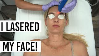 Clear  Brilliant Laser Treatment  Before amp After Vlog  Mom Style [upl. by Ethbinium]