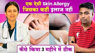 देखिये कैसे Skin Allergy URTICARIA का इलाज हुआ 3 महीनों में  URTICARIA Cure  Dr Upasana Vohra [upl. by Llehsem]