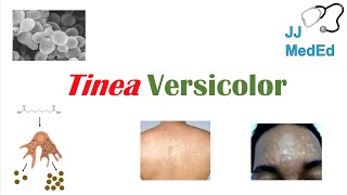 “Fungal Skin Infection of Many Colors” Tinea Versicolor  Pathogenesis Symptoms and Treatment [upl. by Annay]