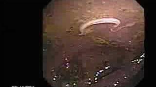 Video Colonoscopy Showing a Parasite in the Cecum [upl. by Osnohpla]