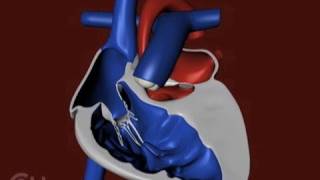 The Structure of a Heart with Hypoplastic Left Heart Syndrome HLHS  CHOP [upl. by Aeret]