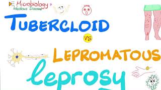 Leprosy  Tuberculoid Leprosy vs Lepromatous Leprosy  Comparisons Playlist [upl. by Seaver]