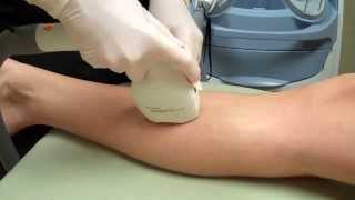 LightSheer Duet Laser Hair Removal on a Womans Legs [upl. by Asyar721]