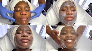 MICRODERMABRASION FOR ACNE SCARS [upl. by Okwu696]