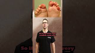 Raynauds Syndrome When Your Toes Hands or Feet Turn Red or White [upl. by Amilb173]