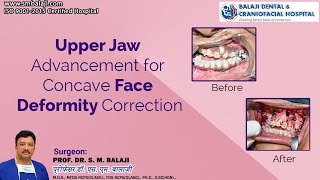 Upper Jaw Advancement for Concave Face Deformity Correction [upl. by Ynnub]