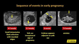 Early Pregnancy Failure A simplified Ultrasound Approach [upl. by Genisia]