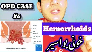 Hemorrhiods ❤️ General OPD CASE 6❤️ hemorrhoids piles بواسیر Treatment medication [upl. by Ettezus]