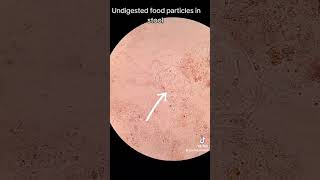 Undigested food particles in stool [upl. by Sprage349]