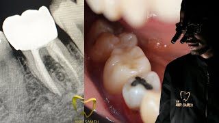 Furcation Perforation Repair Protocol  Restoring Badly Destructed Tooth  Dental Case [upl. by Mitchell]