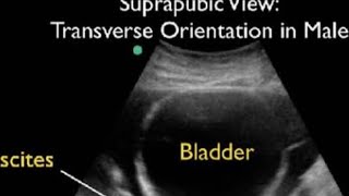 ultrasound ascitic with mesenteric cyst pid pod लड़का लड़की भी कर सकती ह अल्ट्रासाउंड। [upl. by Kind]