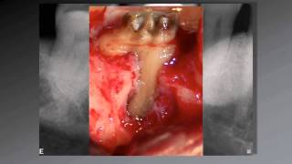 036 El uso de aumento en Endodoncia [upl. by Bolt]