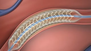 Absorbable Stent [upl. by Leuqram]