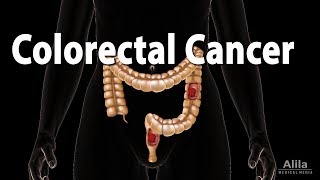 Colon Cancer Pathology Symptoms Screening Cause and Risk Factors Animation [upl. by Ecirehc71]