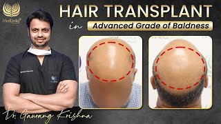 Hair Restoration in Advanced Grade of Baldness  Hair Transplant Doctor in Delhi  Medlinks [upl. by Nueoht840]