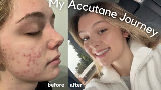 My Accutane Journey [upl. by Dasi]