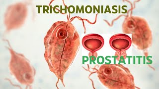 TRICHOMONIASIS ROLE IN PROSTATITIS [upl. by Terrijo157]