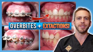 How Do BRACES FIX Overbites  Overbite Before and After Braces  Premier Orthodontics [upl. by Daria]