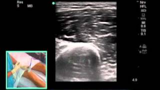 UltrasoundGuided Saphenous Nerve Block  SonoSitemp4 [upl. by Eivad]