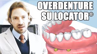 LOverdenture su Locator® protesi su attacchi HD [upl. by Ardiedak723]