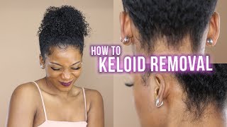 HOW I GOT RID OF MY KELOIDSLIVE INJECTIONS PROCEDURE  EARRINGS  EARLUMS CLIPS  Annesha Adams [upl. by Eikceb]