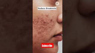 Best cream for pimples acne black heads white heads [upl. by Eniahs524]