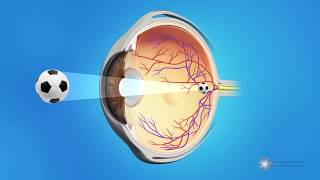 Posterior Capsule Opacification PCO  Also known as Secondary Cataracts or Cataract Scar Tissue [upl. by Creight211]