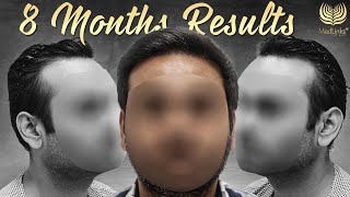 Amazing Hair Transplant Journey  8Month Hair Transplant Results  MedLinks [upl. by Yuh]