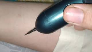 Plasma Pen for Mole and Wart removal [upl. by Trstram]