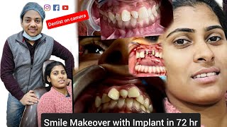 Smile Makeover in 3 days with Corticobasalimplant amp Zirconia crowns  Dr Mangal Gupta [upl. by Ynattir]