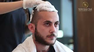 How To Remove The Scabs After Hair Transplant 2023  Now Hair Time [upl. by Iams]